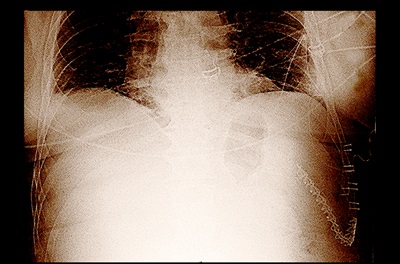 A chest x-ray demonstrating titanium plates used to knit a separated rib to the thoracic cage after chest wall injury.